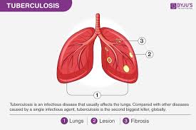 Image result for Extrapulmonary Tuberculosis