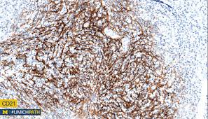 J cancer res immunooncol 5: Michigan Pathology On Twitter A Angioimmunoblastic T Cell Lymphoma Clin Aggressive Derived From Follicular Helper T Cell A W Eosinophilia Poly Igg Histo T Cells W Clear Cytoplasm Prolif Of Fdcs Arborizing Hev Ihc Cd4 Cd10