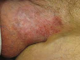 Extramammary Paget S Disease Of The Scrotum With Complete Response To Imiquimod And Photodynamic Therapy Bmj Case Reports