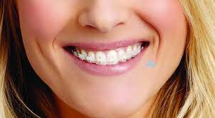 When moving to ireland, remember to get a copy of your medical history as well as any ireland provides a free breast cancer screening program to residents of ireland aged 50 to 69. Braces Ace Braces O Regan Orthodontics Teeth Straightening Ireland Braces Tullamore