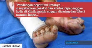 Penyakit kusta adalah infeksi yang menyebabkan pembengkakan kulit dan kerusakan saraf parah di bagian lengan, kaki dan kulit di seluruh badan. Stigma Diskriminasi Sumbang Penularan Penyakit Kusta Dr Noor Hisham