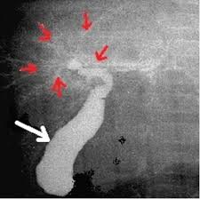 Infants often have jaundice in the first 2 weeks of life, so it is not easy to identify biliary atresia in newborn infants. Comparison Of Mrcp With Intraoperative Cholangiography In Paediatric Choledochal Cyst And Biliary Atresia