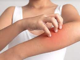 Penyebab gatal pada kulit adalah kulit kering, penyakit kulit, alergi, hingga penyakit sistemik. Atasi Kulit Gatal Dengan Vitamin D Apakah Efektif