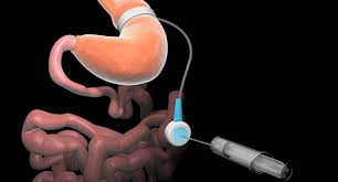 Weight loss surgery (also known as bariatric surgery) is not universally covered by insurance companies. Which Weight Loss Surgery Is Best