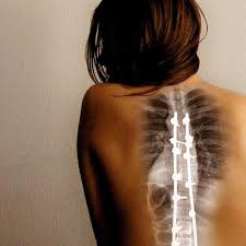 Pin On Scoliosis