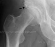 Image result for icd 10 code for subchondral cyst