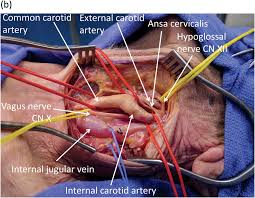 The internal jugular vein (v. Carotid Artery And Internal Jugular Vein Injuries Chapter 8 Atlas Of Surgical Techniques In Trauma