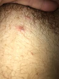 Bumps on and around penis from razor bumps can be prevented through proper shaving techniques and change your hair removal methods. Anyone Know What These 3 Bumps Are On My Pubic Area Ingrown Hair Cysts Popping