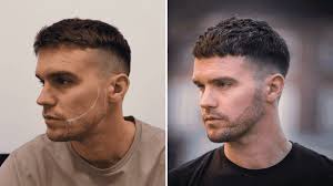 Gaz Beadle Beard Transplant at KSL Clinic // See the results here