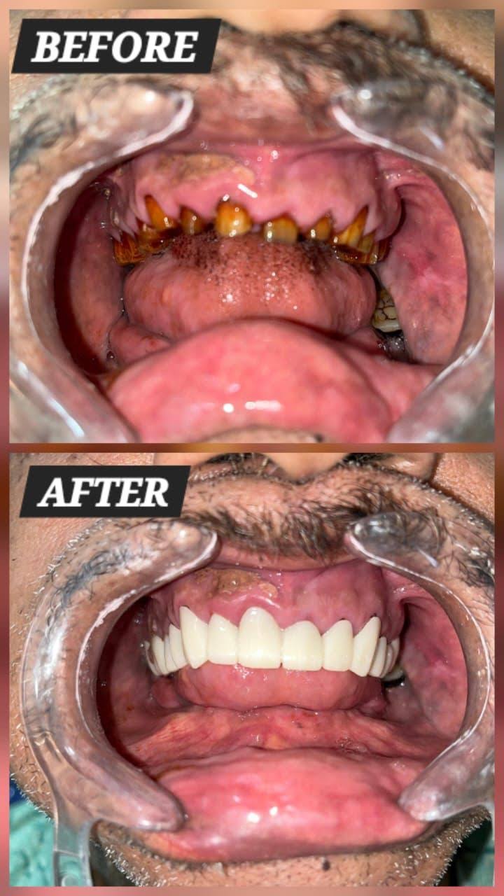 Full Mouth Regabilitation product image