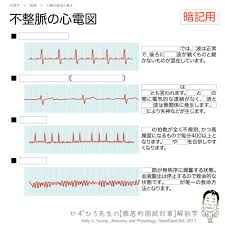 不整脈の心電図 房室ブロック 心房細動 心室細動 2度房室ブロック 2度房室ブロックでは p波は正常で 後ろにqrs波が続くものと続かないものが混在しています 3度房室ブロック 完全房室ブロック 3度房室ブロックは完全房室ブロックとも言われます 心房