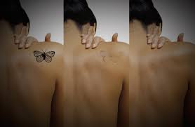 New picosecond pulse technology, outstanding results. Laser Tattoo Removal Blackpool The Fylde Clinic