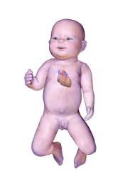 Blue Baby Syndrome Wikiwand