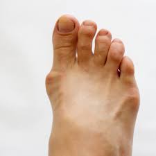 تعرف على مرض النقرس بالصور ويب طب