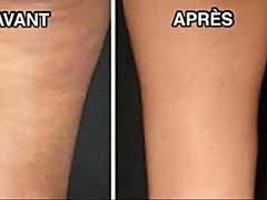 Epingle Sur Cellulite