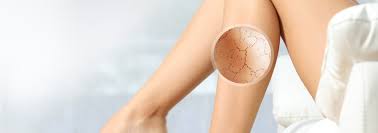 Lazerle Catlak Tedavisi Cilt Catlaklari Stria Istanbul