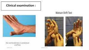 Image result for Scaphoid Shift Test