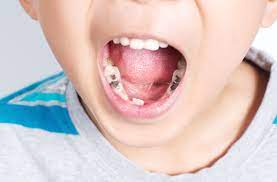 Salah satu cara untuk mengobati sakit gigi yang telah dikenal kuat dengan berkumur air garam hangat. 9 Obat Sakit Gigi Anak Untuk Meredakan Nyerinya Salah Satunya Dengan Paracetamol Orami