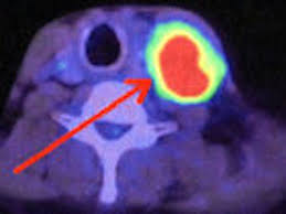 These areas typically include different parts of the head, neck and chest. Cancer Types Carcinoma Sarcoma Leukemia Lymphoma Healthline