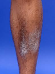 Image result for Lichen Simplex Chronicus