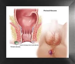 Image result for Perianal Abscess