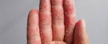 Ein atopisches ekzem, auch neurodermitis oder atopische dermatitis genannt, ist eine chronisch entzündliche hauterkrankung, die schubweise verläuft. Ekzem Am Finger Was Sind Die Ursachen Und Wie Wird Behandelt