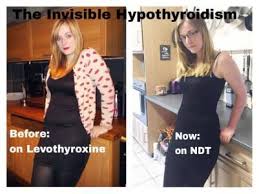 Pin On Hypothyroidism