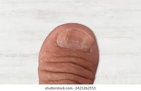 Image result for Koilonychia feet