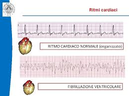La fibrillazione ventricolare è un problema del ritmo cardiaco che i verifica quando il cuore batte con impuli elettrici rapidi e irregolari. Azienda Ospedaliero Universitaria Pisana U O Iv Anestesia