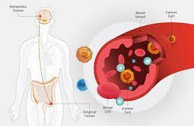 Learn about bowel cancer symptoms bowel cancer can be treated using a combination of different treatments, depending on where the cancer is in your bowel and how far it has spread. Metastatic Colorectal Cancer May Spread Early National Cancer Institute