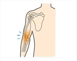 Distal Biceps Tendonitis - Upswing Health | Upswing Health