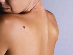 Un grain de beauté qui change de forme,de couleur.c'est pas bon signe. 8 Symptomes De Maladie Reveles Par Votre Peau Selection Ca