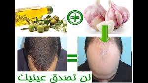 علاج تساقط الشعر بالثوم وزيت الزيتون لن تصدق نفسك إدا جربتها Youtube
