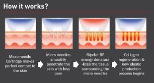 Normal skincare can be resumed. Secret Rf Tighten And Rejuvenate Skin With Fractional Rf Radiofrequency Microneedling Serenity Medspa