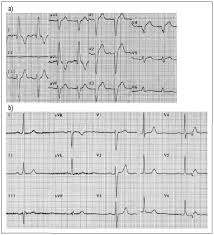 Son mucho menos frecuentes los. Recurrencia De Miocardiopatia Por Estres Posterior A Terremoto En Chile Reporte De Un Caso Clinico
