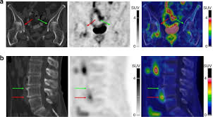Téléchargez des modules gratuits, obtenez des conseils d'orientation et profitez de nos réductions. Toward Diagnostic Relevance Of The A V B 5 A V B 3 And A V B 6 Integrins In Oa Expression Within Human Cartilage And Spinal Osteophytes Bone Research