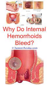 Pin On Remedies For Hemorrhoids