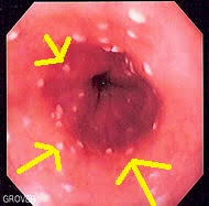 Esophageal ulcers are a type of peptic ulcer that develops between the throat and the stomach. Esophageal Candidiasis Differential Diagnosis Wikidoc