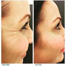 Do i have to take it consistently or just as needed? Under Eye Treatments Crow S Feet Skinspirit