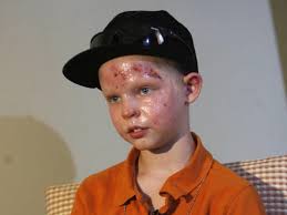 It was really scary': Boys recall fire, explosion that burned them