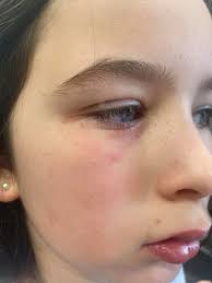 What to do for swollen eyes due to salt water reaction in Gulf Shores?