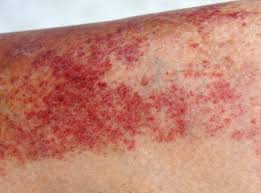 Image result for contact dermatitis