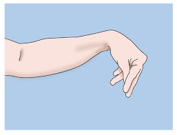 The chvostek sign (/ˈkvɒstɪk/) is a clinical sign of hypocalcemia. Trousseau Sign Article