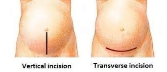 In some cases, however, your health care . Oh Baby Now That S A Scar Scar Release C Sections The Nesting Place Li