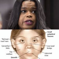 Flat nasal bridge and epicanthal folds / fasd google. Flat Nasal Bridge And Epicanthal Folds A Case Of Raine Syndrome Presenting With Facial Dysmorphy And