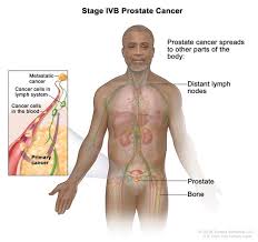 The american cancer society estimates that over 21,000 people in the united states will be diagnosed with ova. Definition Of Stage Iv Prostate Cancer Nci Dictionary Of Cancer Terms National Cancer Institute