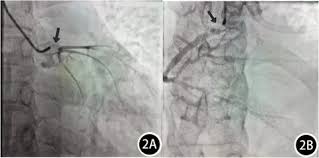 Image result for Cardiovascular Syphilis