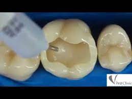 Saya pun tak ingat bila gigi tu kena tampal. Tampal Gigi In English Kahanan