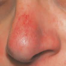 Image result for demodex rosacea