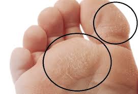 Image result for diabetic toes